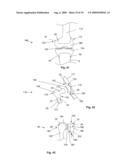 BONE PROSTHESIS diagram and image