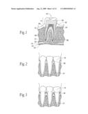 Expandable polymer dental implant and method of use diagram and image