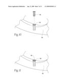 Expandable polymer dental implant and method of use diagram and image