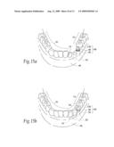 Expandable polymer dental implant and method of use diagram and image