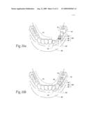 Expandable polymer dental implant and method of use diagram and image