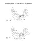 Expandable polymer dental implant and method of use diagram and image