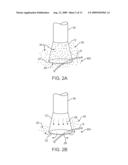 STENT DELIVERY UNDER DIRECT VISUALIZATION diagram and image