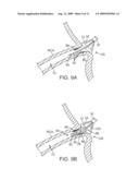 STENT DELIVERY UNDER DIRECT VISUALIZATION diagram and image