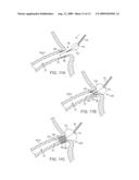 STENT DELIVERY UNDER DIRECT VISUALIZATION diagram and image