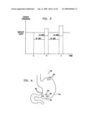 GI Lead Implantation diagram and image