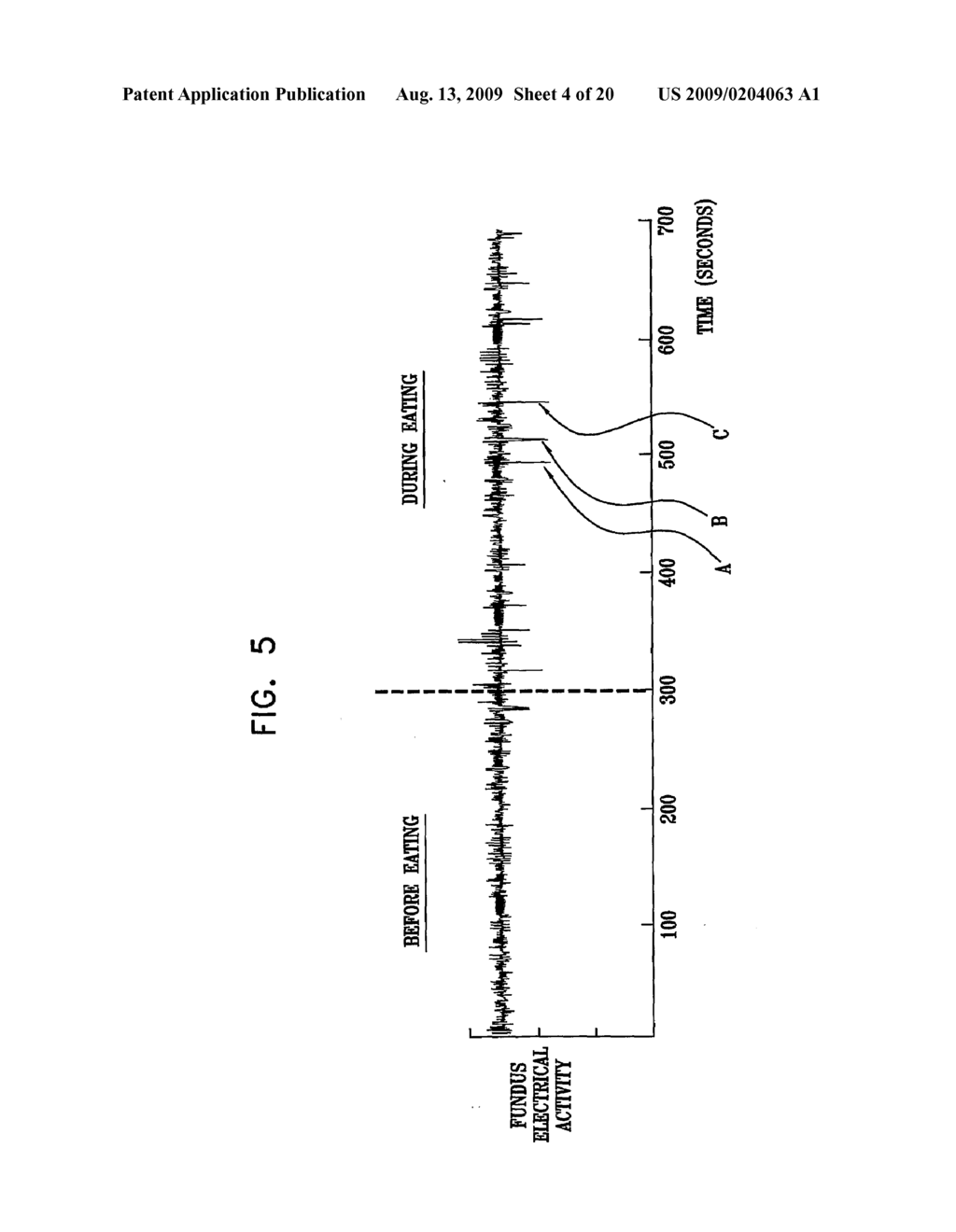 GI Lead Implantation - diagram, schematic, and image 05