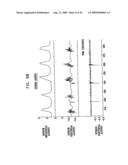 GI Lead Implantation diagram and image