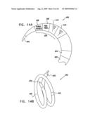 GI Lead Implantation diagram and image