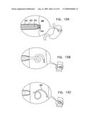 GI Lead Implantation diagram and image