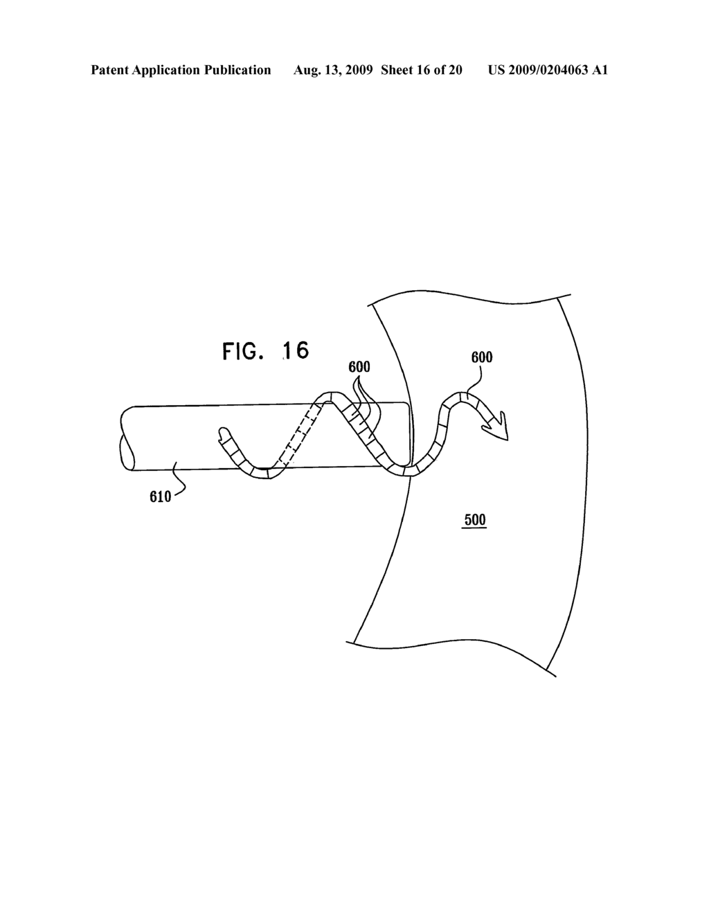 GI Lead Implantation - diagram, schematic, and image 17