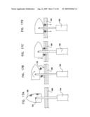 GI Lead Implantation diagram and image