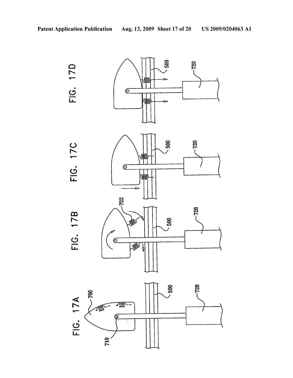 GI Lead Implantation - diagram, schematic, and image 18