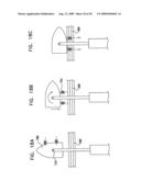 GI Lead Implantation diagram and image