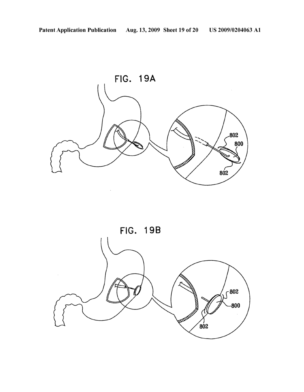 GI Lead Implantation - diagram, schematic, and image 20