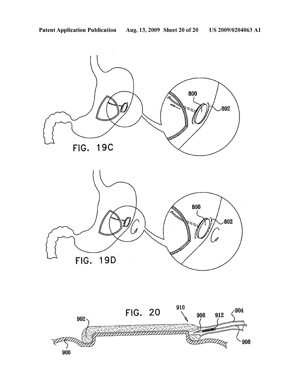 GI Lead Implantation - diagram, schematic, and image 21