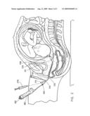 Cervical dilating and ripening catheter system and method diagram and image