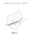 Method for Soft Tissue Attachment diagram and image