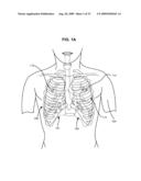 ACCELERATED TWO-PHASE SURGICAL PROCEDURE FOR CREATING A PNEUMOSTOMA TO TREAT CHRONIC OBSTRUCTIVE PULMONARY DISEASE diagram and image