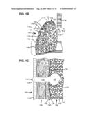 ACCELERATED TWO-PHASE SURGICAL PROCEDURE FOR CREATING A PNEUMOSTOMA TO TREAT CHRONIC OBSTRUCTIVE PULMONARY DISEASE diagram and image