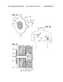 METHODS AND DEVICES FOR FOLLOW-UP CARE AND TREATMENT OF A PNEUMOSTOMA diagram and image