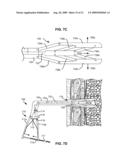 METHODS AND DEVICES FOR FOLLOW-UP CARE AND TREATMENT OF A PNEUMOSTOMA diagram and image