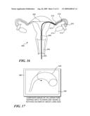 EFFICIENT AUTOMATED UROTHELIAL IMAGING USING AN ENDOSCOPE WITH TIP BENDING diagram and image