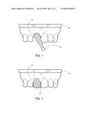 Notched pontic and system for fabricating dental appliance for use therewith diagram and image