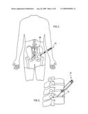 KIT FOR ADMINSTERING A THERAPEUTIC AGENT INTO TISSUE diagram and image