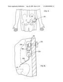 KIT FOR ADMINSTERING A THERAPEUTIC AGENT INTO TISSUE diagram and image