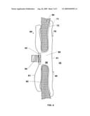 Device and Method for Closure of Atrial Septal Defects diagram and image