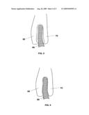 Device and Method for Closure of Atrial Septal Defects diagram and image