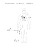 DEVICE FOR IMPLANTING AN OCCLUSION DEVICE IN THE HEART diagram and image