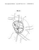 UNIVERSAL ANNULOPLASTY SYSTEM diagram and image