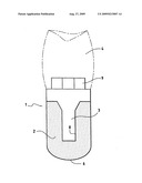 Dental implant with porous trabecular structure diagram and image