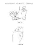 ELECTROSURGICAL METHOD AND SYSTEM FOR TREATING FOOT ULCER diagram and image