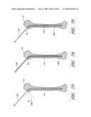 MODULAR SEGMENTED INTRAMEDULLARY SYSTEM, APPARATUS AND METHODS diagram and image