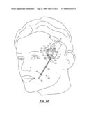 Surgical suturing device, method and tools used therewith diagram and image