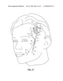 Surgical suturing device, method and tools used therewith diagram and image