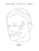 Surgical suturing device, method and tools used therewith diagram and image