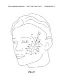 Surgical suturing device, method and tools used therewith diagram and image