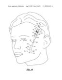 Surgical suturing device, method and tools used therewith diagram and image