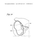 IMPLANTABLE CLOSURE APPARATUS AND METHODS diagram and image