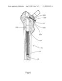 Femoral Hip Prosthesis and Method of Implantation diagram and image
