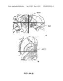 Image Guidance System for Deep Brain Stimulation diagram and image