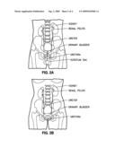 METHODS FOR TREATING A STRICTURE WITH A BOTULINUM TOXIN diagram and image