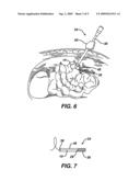 INTRALUMINAL TISSUE MARKERS diagram and image