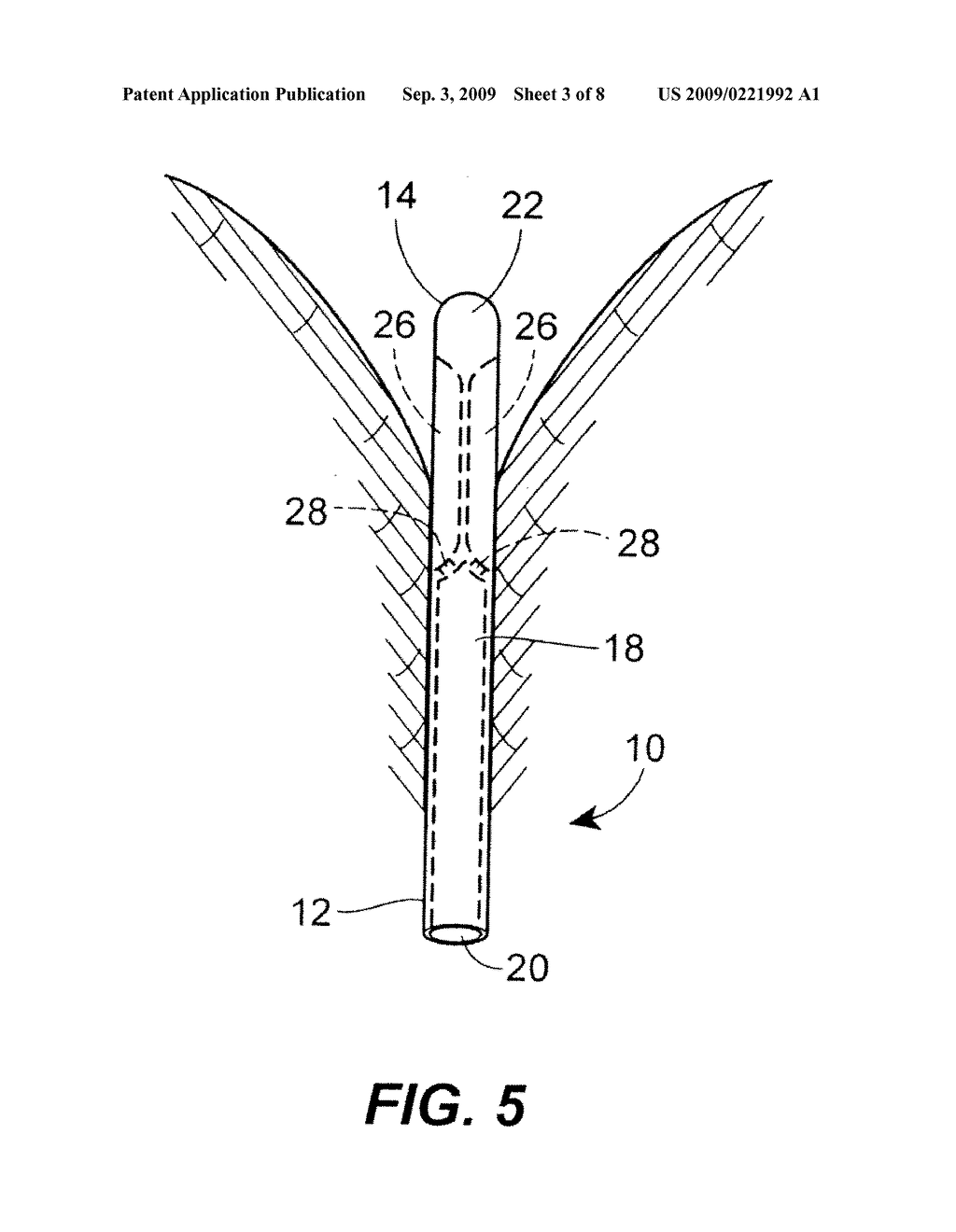 Fluid Drainage Catheter Having an External Flow Path - diagram, schematic, and image 04