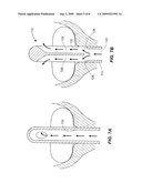 Fluid Drainage Catheter Having an External Flow Path diagram and image