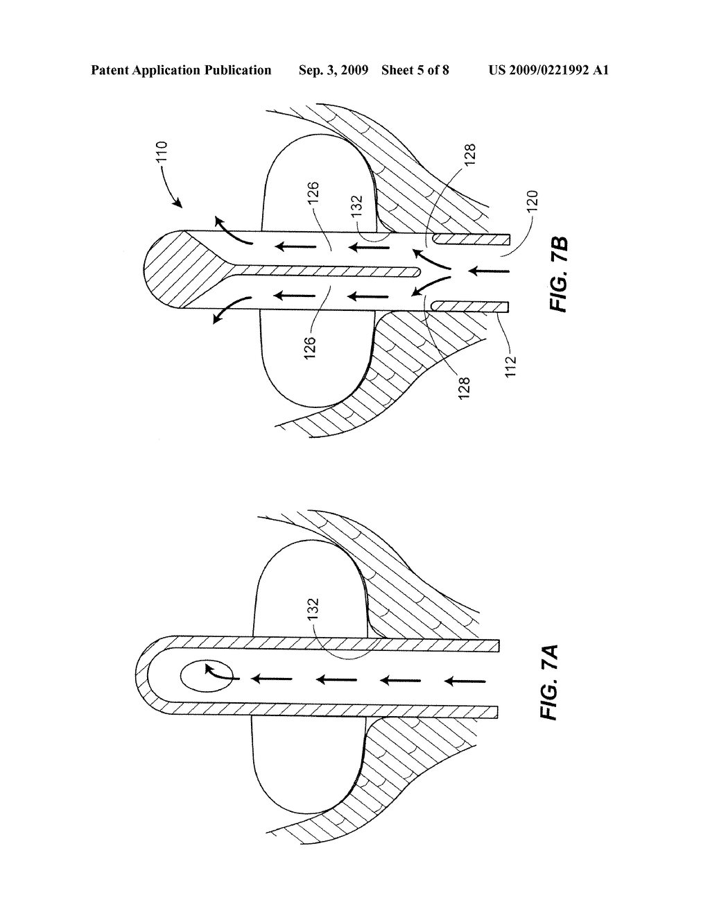 Fluid Drainage Catheter Having an External Flow Path - diagram, schematic, and image 06